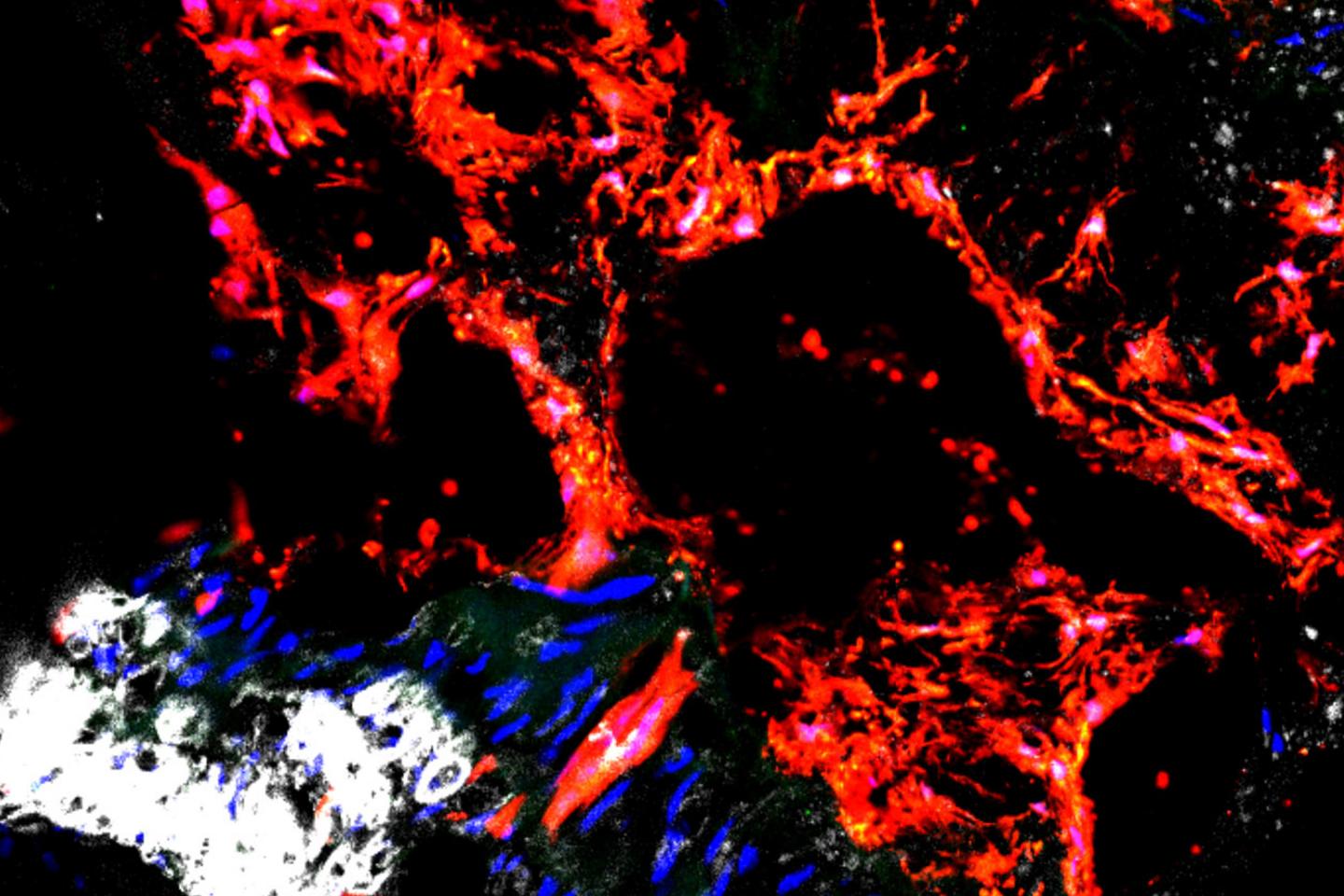 Scientists find Culprit Responsible for Calcified Blood Vessels in Kidney Disease