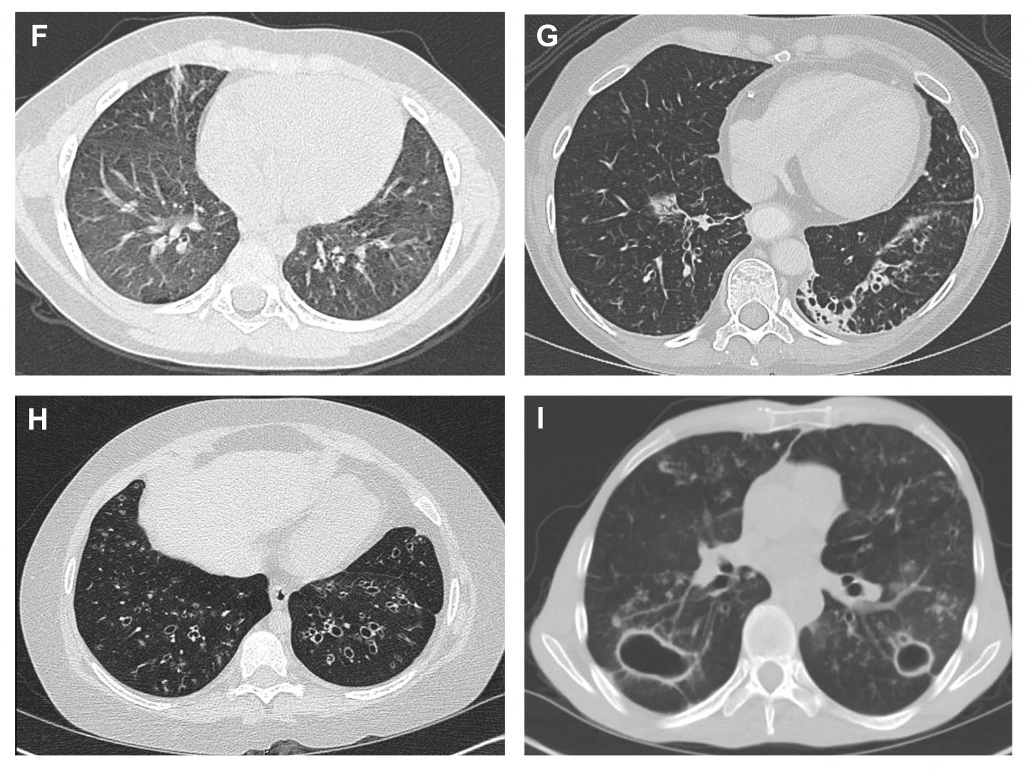 Combating Undetected Lung Inflammation in Pat | EurekAlert!