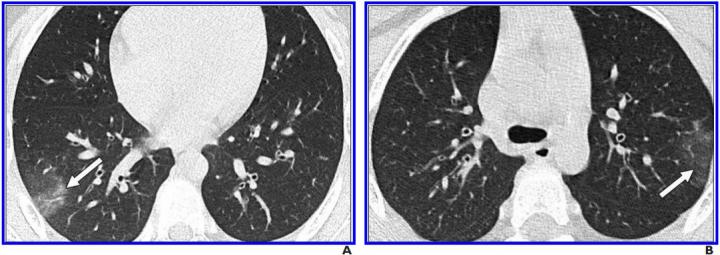 8-Year-Old Boy with COVID-19