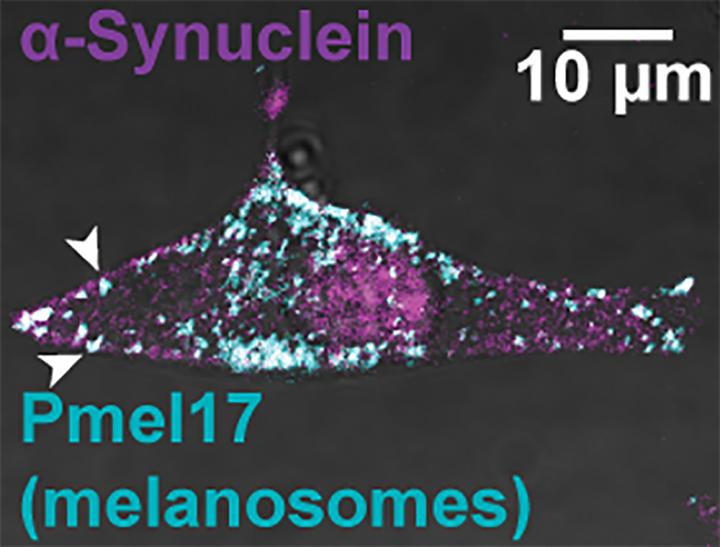 Human Melanoma Cell Immunostained For &#913;-Synuclein and Melanosomes