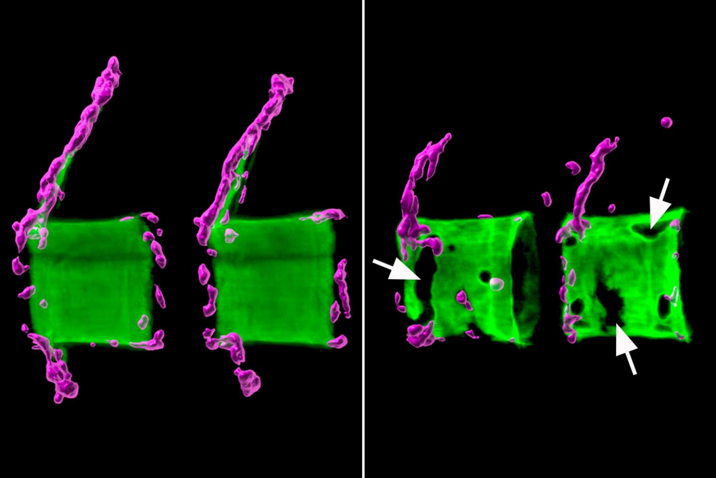 Osteoporosis in Vertebral Bodies