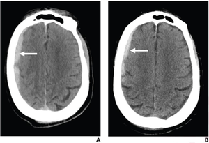 76-Year-Old Patient, Not on Antithrombotic Therapy, Presenting to ED After Ground-Level Fall