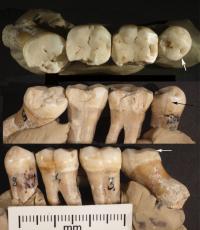 Toothpick Grooves on 4 Neanderthal Teeth