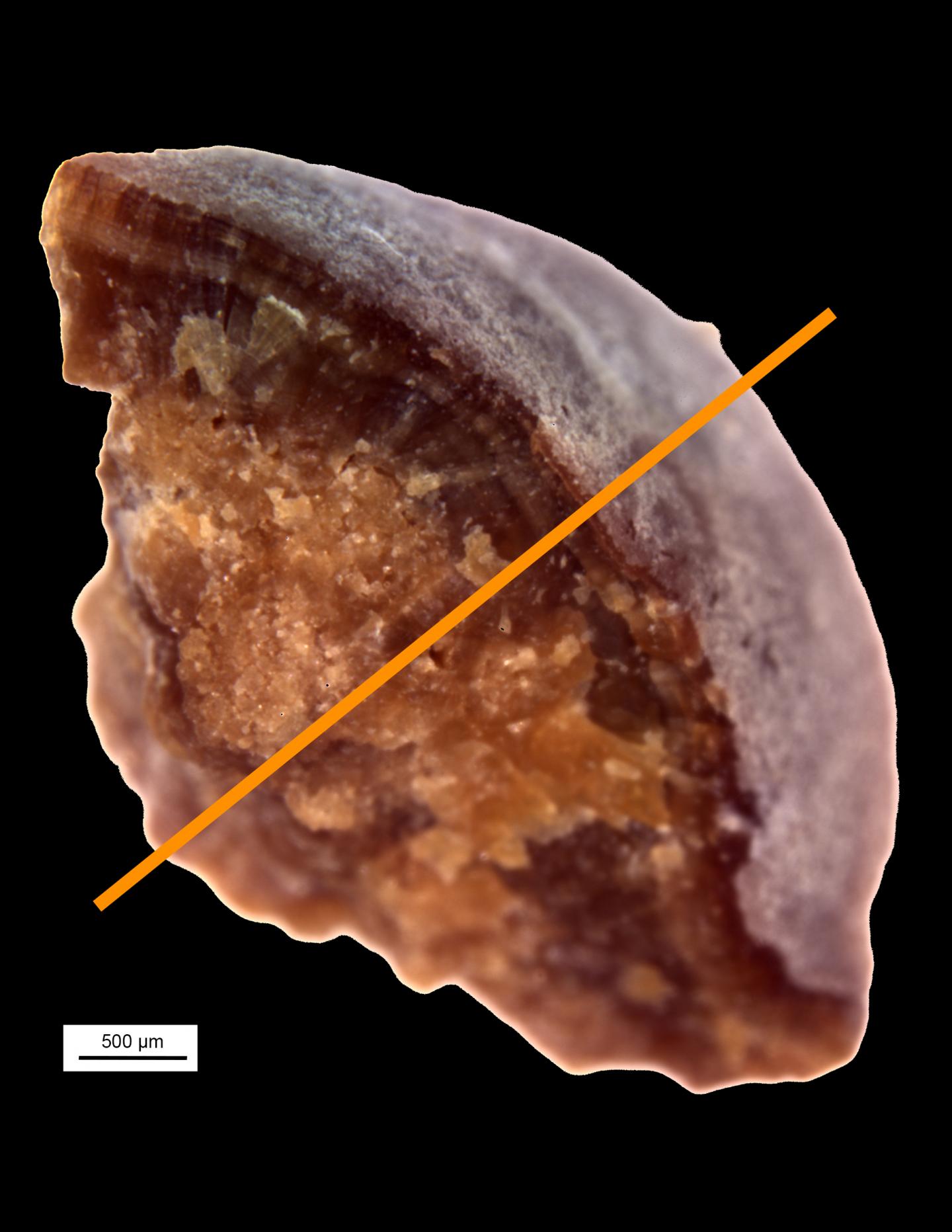 Kidney Stone