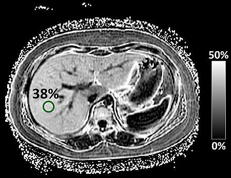 MRI of NAFLD
