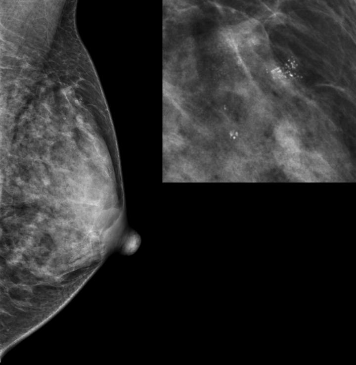 Which Benign Breast Disease Is [IMAGE] EurekAlert! Science News Releases