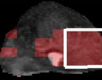 MRI Identification of Prostate Cancer