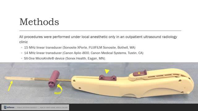 Minimally Invasive Ultrasound-Guided Carpal Tunnel Release Improves Long-Term Clinical Outcomes