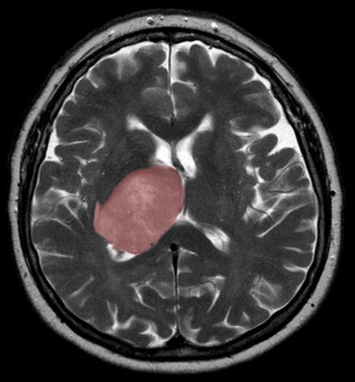 A glioblastoma tumour