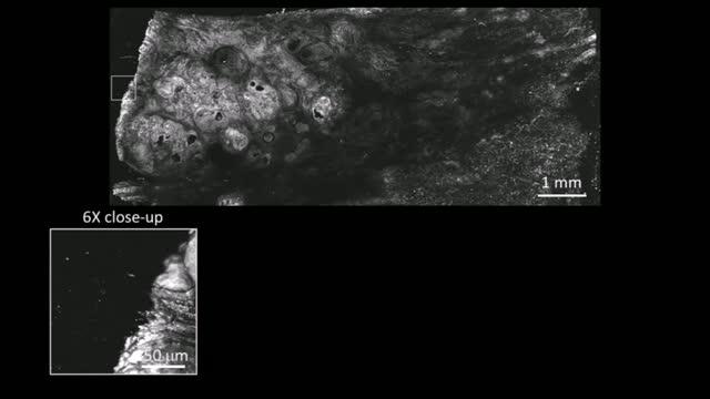 Multilayered Histology-Like Imaging of Human Breast Cancer by Photoacoustic Microscopy (3 of 4)