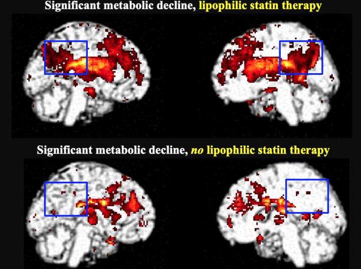 Significant metabolic decline in the posterior cingulate cortex in lipophilic statin users