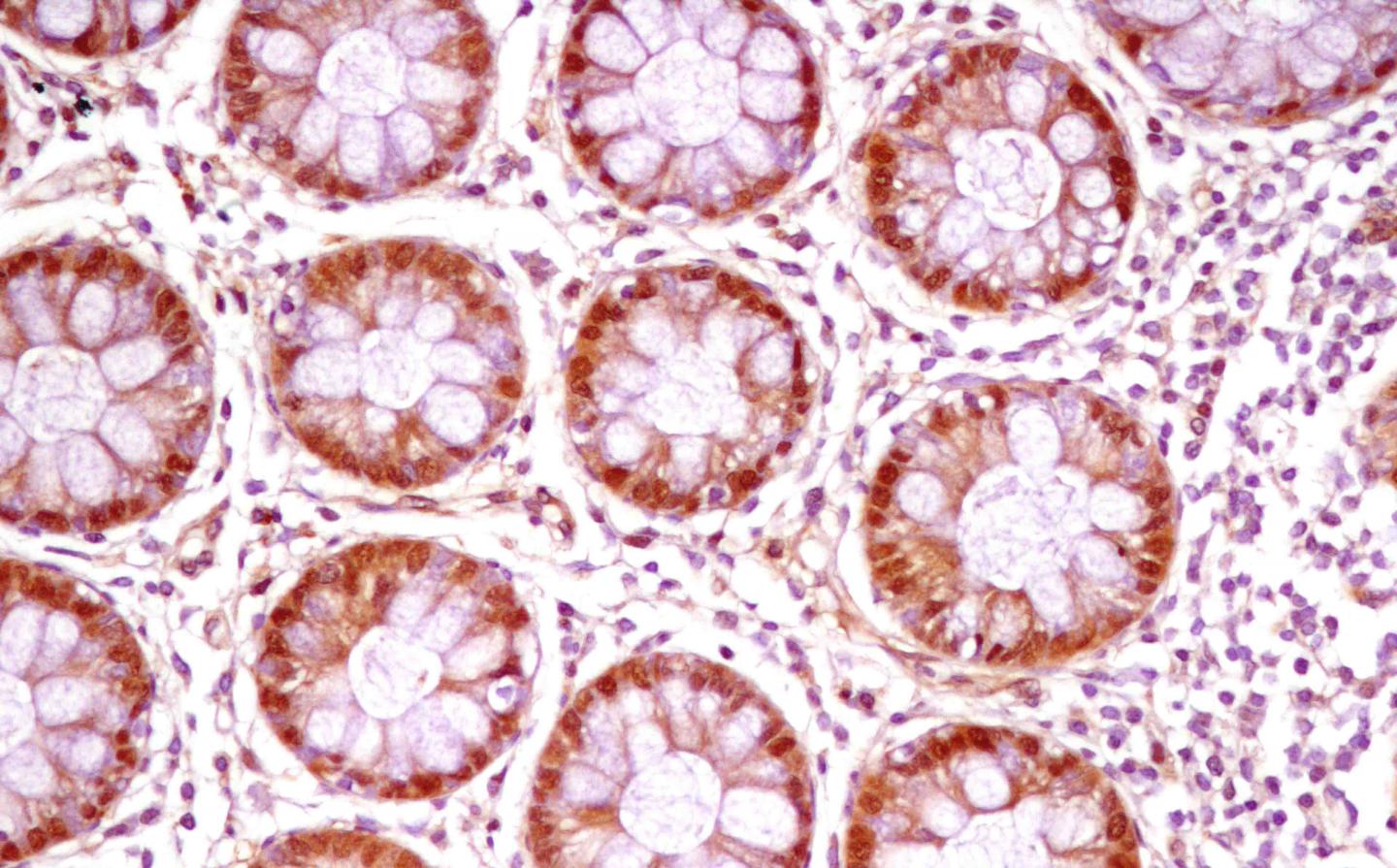 Cross-Section of the Inner Lining of a Cancerous Tumor