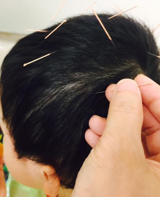 An autistic child patient receives scalp acupuncture treatment