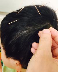 An Autistic Child Patient Receives Acalp Acupuncture Treatment
