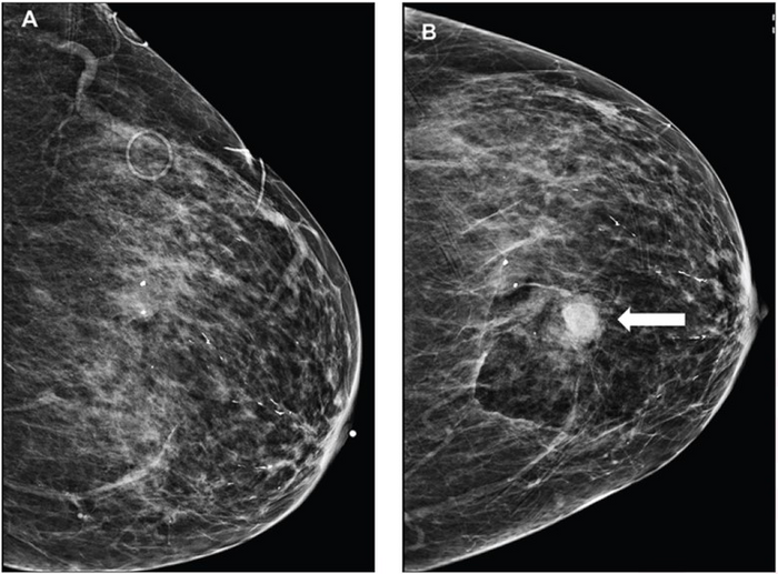 85-year-old patient who maintained daily use of 81 mg of aspirin at time of stereotactic-guided core-needle biopsy of group of breast calcifications; pathologic assessment yielded atypical ductal hyperplasia.