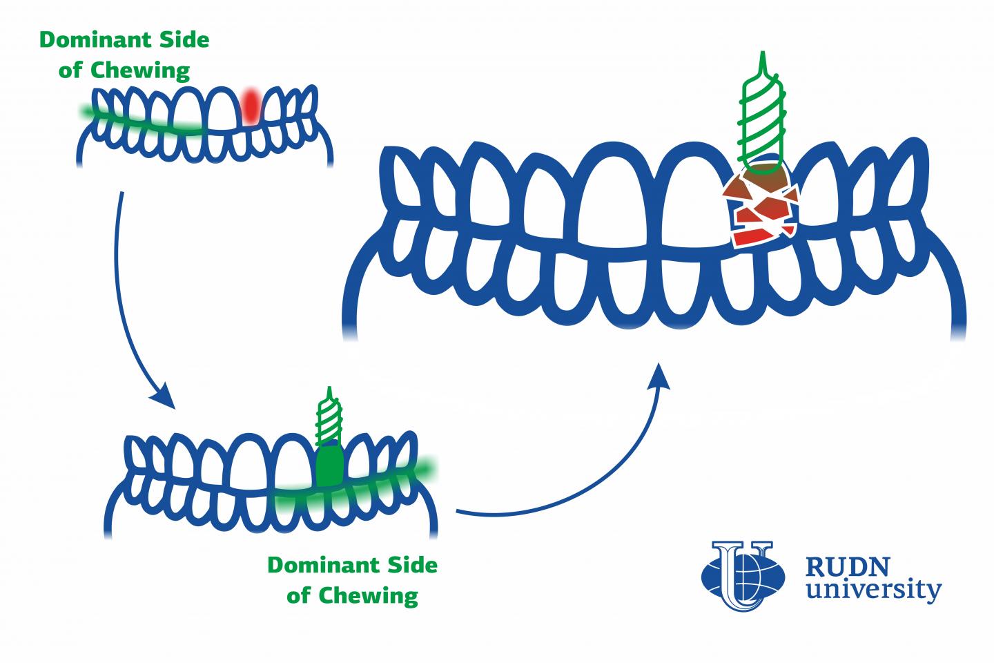 Dentists from RUDN University Found a Reason for Early Deterioration of Dental Implants