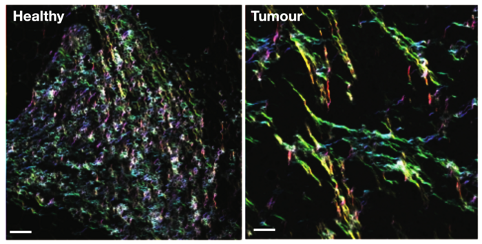 Healthy and tumour matrix