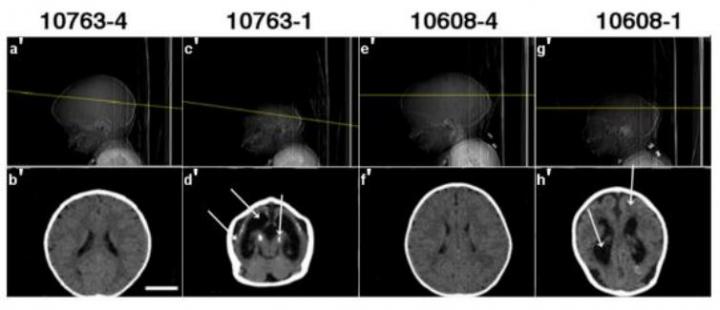 Computed Tomography Scans From Two Pairs of Twins Participant in the Study