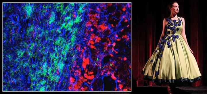 Fashioning Cancer: Glioma