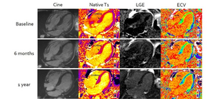 MRI with CMR (T1) and ECV mapping