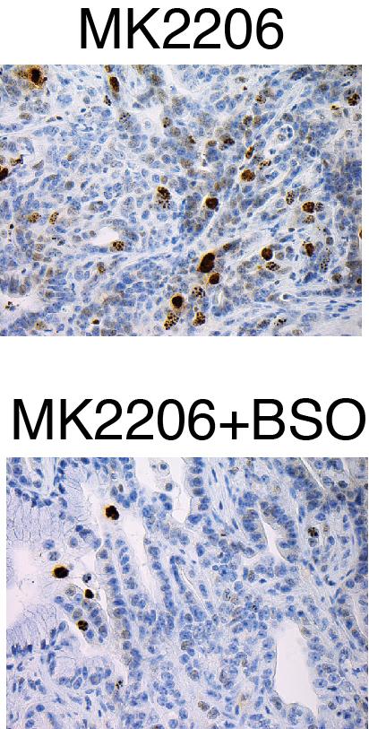 The Power of a Combined Drug Treatment in Pancreas Cancer