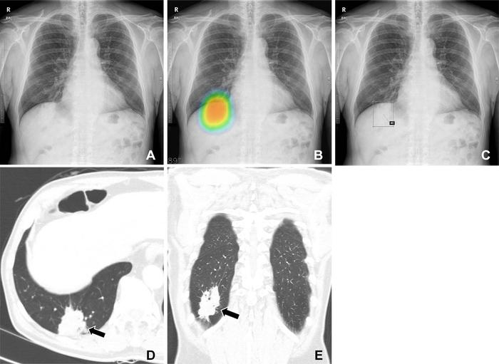 Chest X-rays obtained as part of a health checkup in a 71-year-old male patient