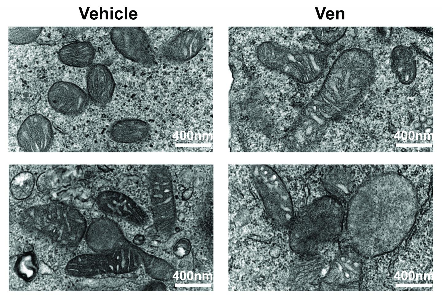 Making Leukemia Tumor Cells Sensitive Again, with the Help of Antibiotics (1 of 2)