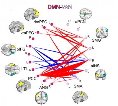 Lagging Brain Connections in ADHD