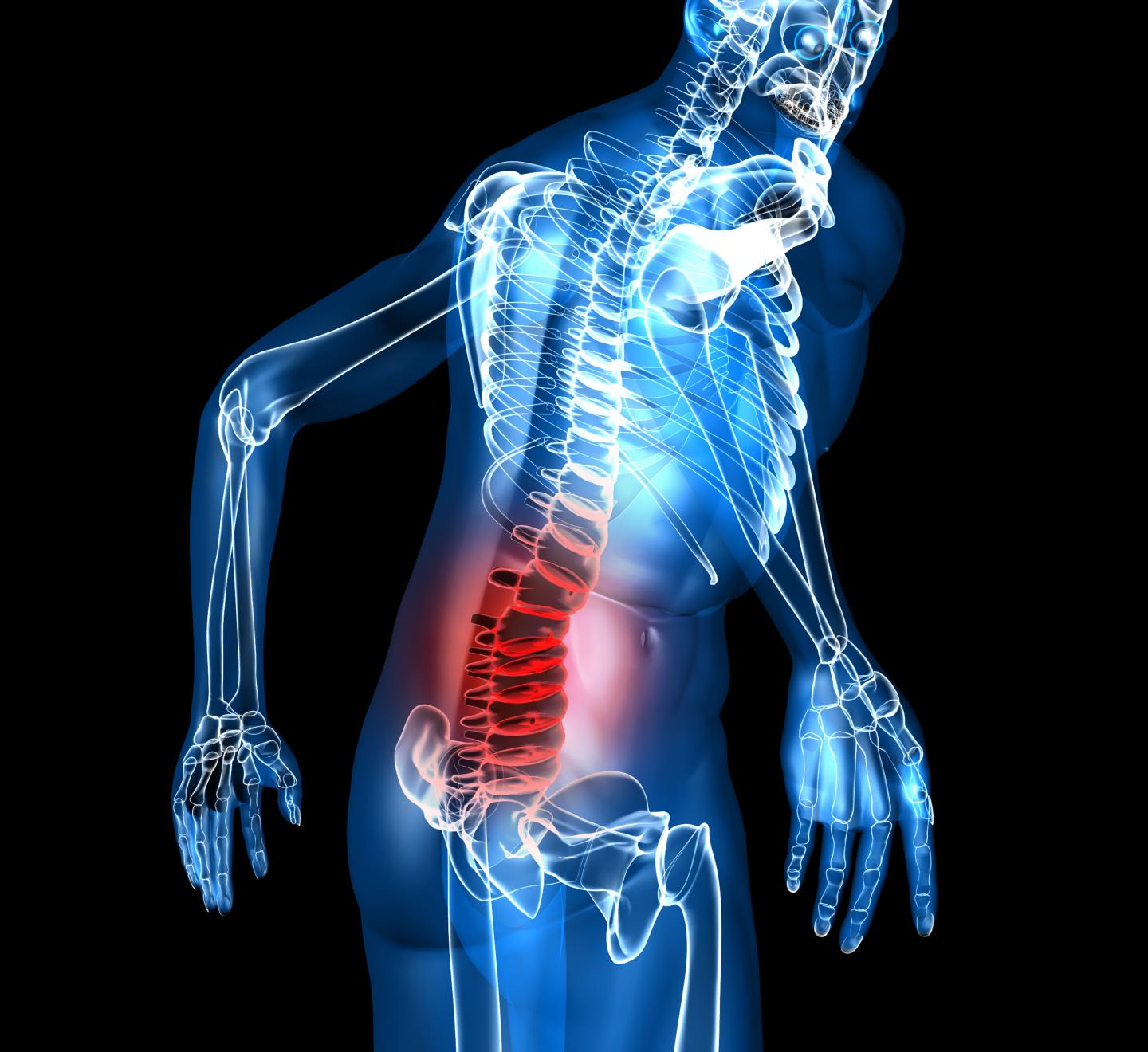 Lower Back Pain Responds Equally to Placebo and Diazepam