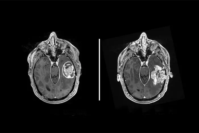 Brain scans of glioblastoma tumors