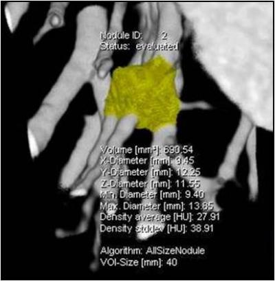 CT Detected Nodule in Lung
