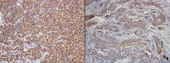 PD-L1 immunohistochemical staining
