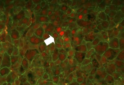 STAT5 Protects Against Liver Cancer