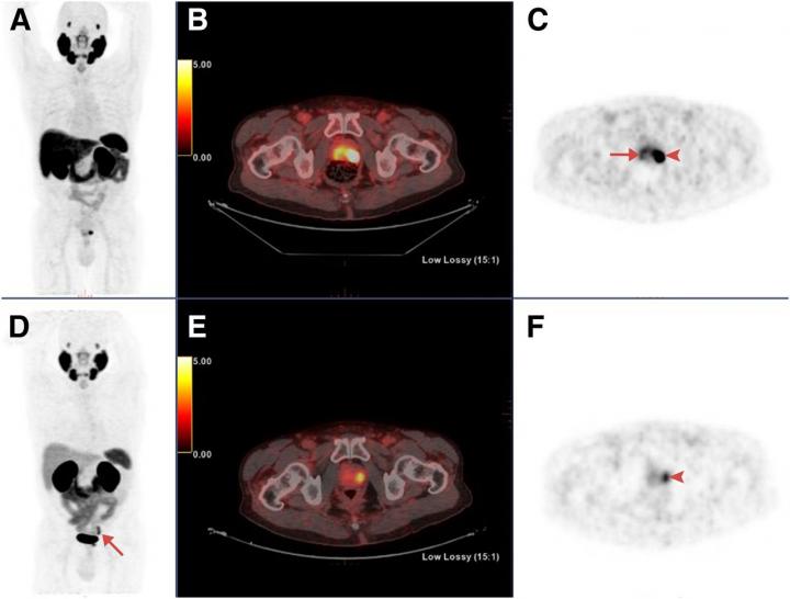 Maximum-Intensity Projections, Transaxial Fusion, and Pet Images of 18F-PSMA1007 and 68Ga-PSMA-11 PE