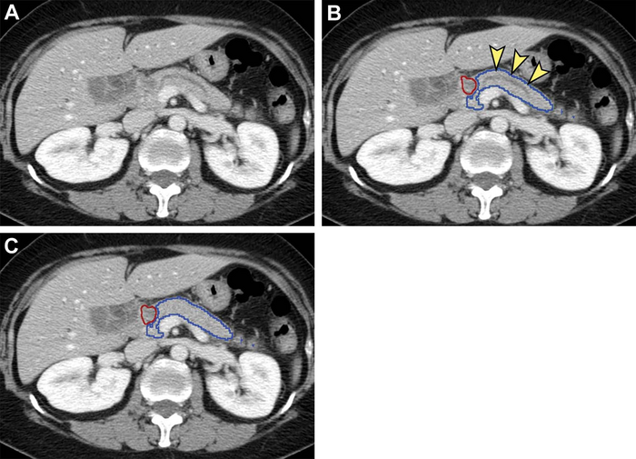 AI Helps Detect Pancreatic Cancer