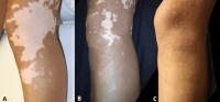 MKTP Surgery Has Long-Term Benefit for Restoring Skin Pigmentation in Vitiligo Patients