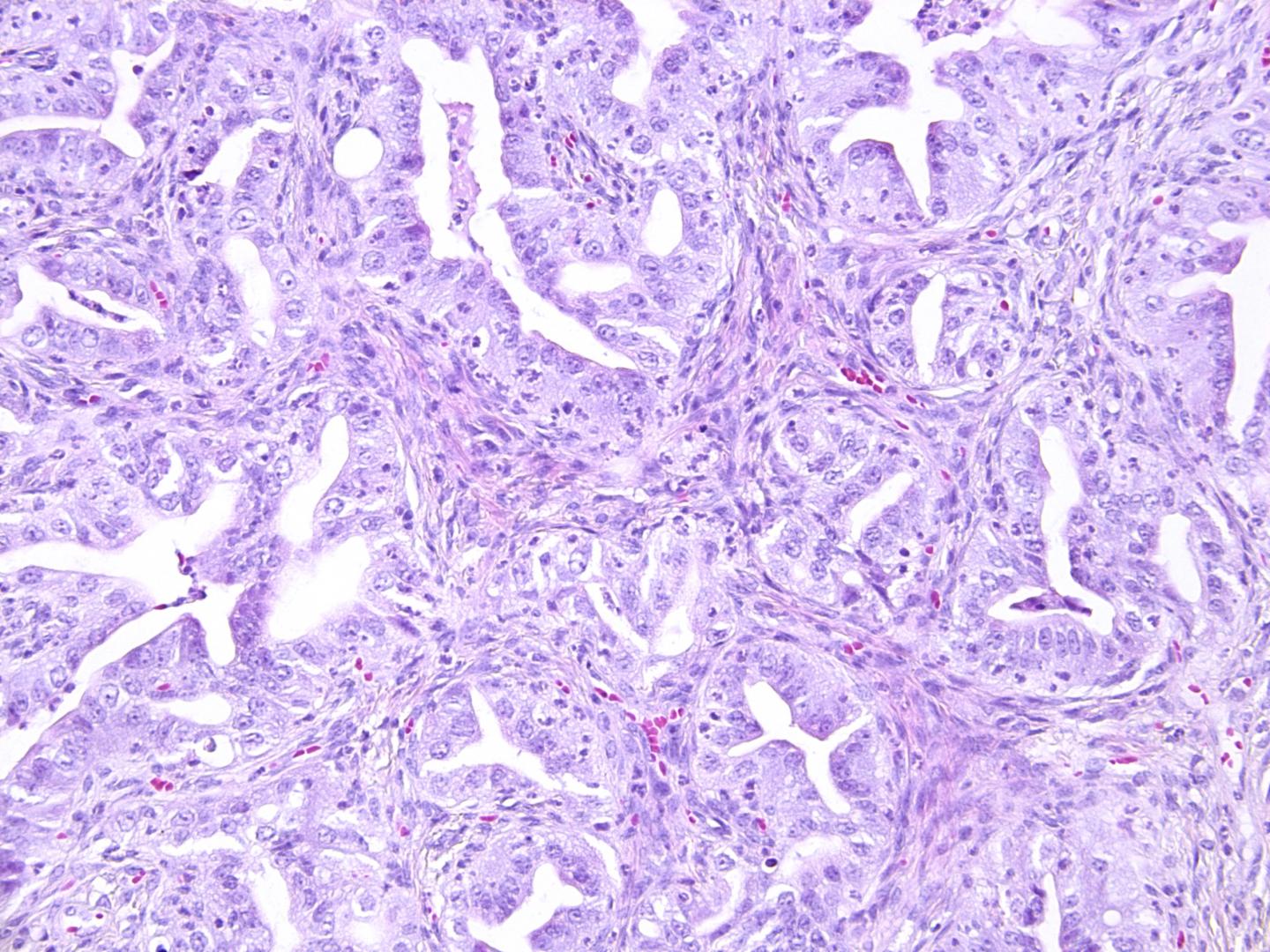 A Tumor Derived from Organoids of the Mouse Oviduct