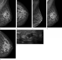 Digital Breast Tomosynthesis Reduces Rate of Interval Cancers