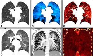 Images in a 34-year-old female patient show severe smoking-associated small airway disease.