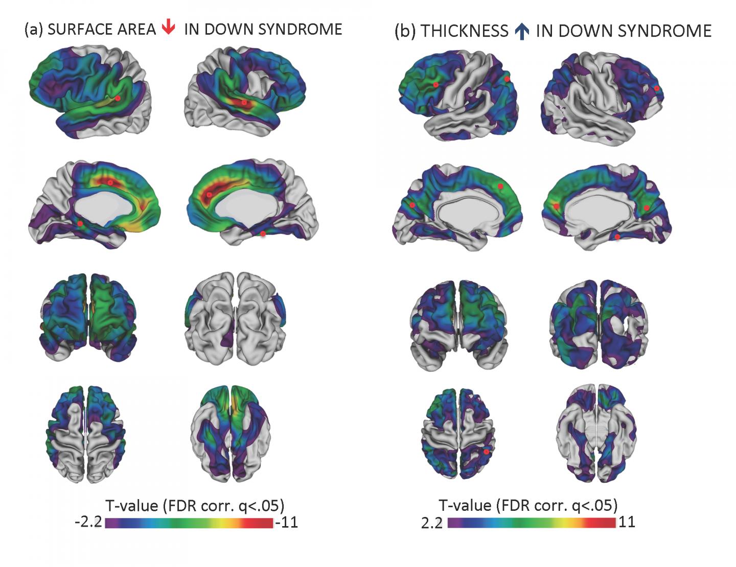 Cortex is Thicker in Brains with Down Syndrome