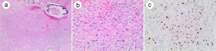 Rhabdomyosarcoma arising from testicular teratoma