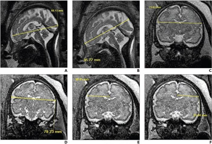 33 year old Patient gestation IMAGE EurekAlert Science News Releases