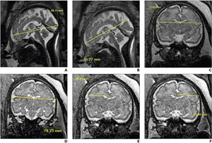 33-year-old patient (gestational age, 30 weeks and 6 days), without in utero opioid exposure, who underwent fetal MRI