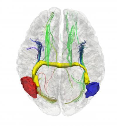 3D Image of Aberrant Interhemispheric Bundles in the Human Brain