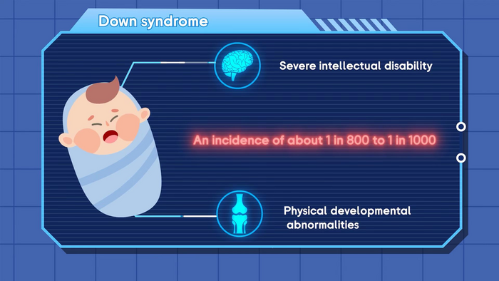 Impact of Down syndrome