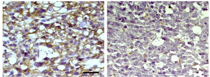 Drug Treatment Reduces PD-L1 Levels in Glioblastoma