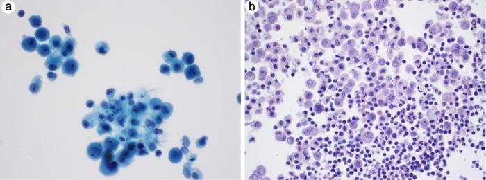 Reactive mesothelial cells, histiocytes, and small lymphocytes