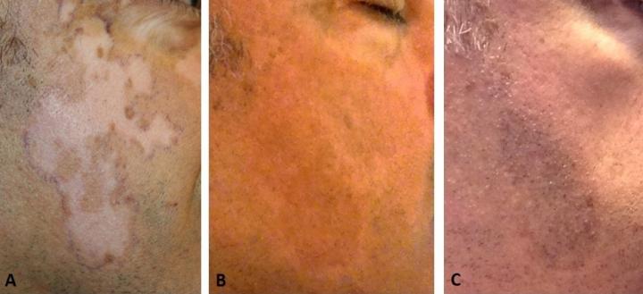 MKTP Surgery Has Long-Term Benefit for Restoring Skin Pigmentation in Vitiligo Patients