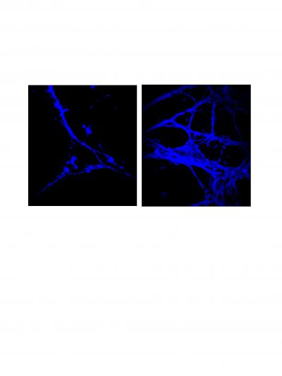 Huntington's Disease and Abnormal Cholesterol Levels in Brain