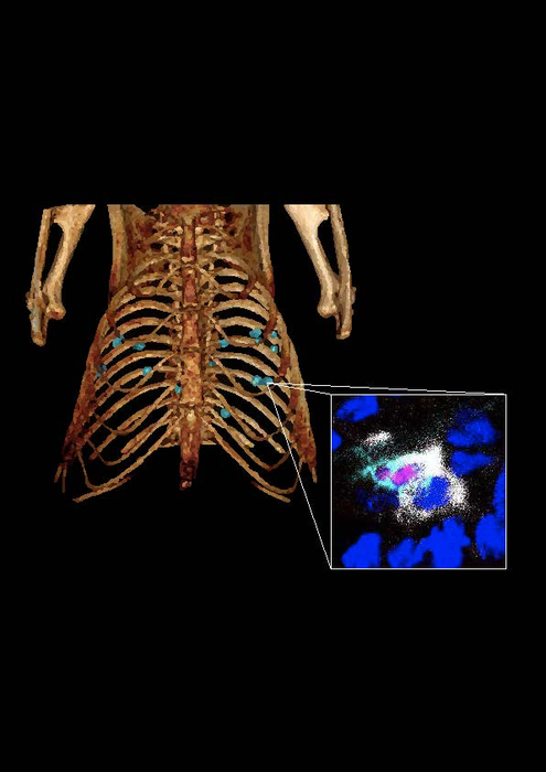 Lung Cancer Nodules Image Eurekalert Science News Releases